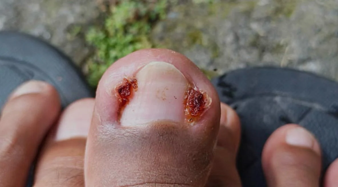 Imagem fornecida de um dedão com alterações nas duas laterais da unha.