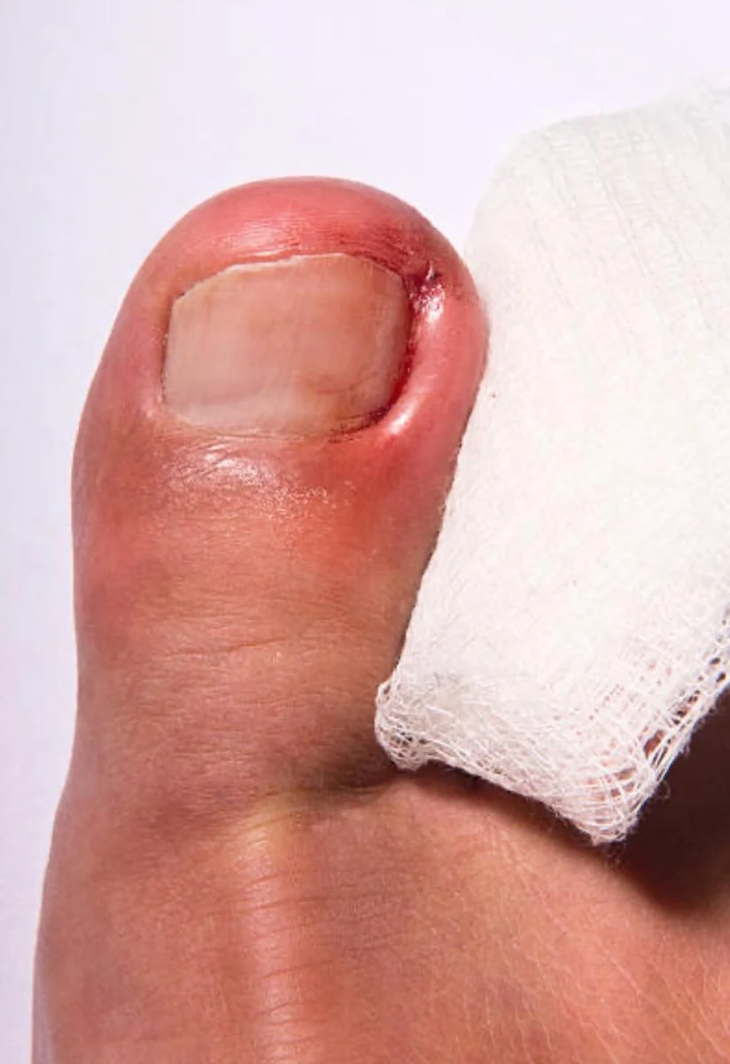 Imagem fornecida de vermelhidão junto à lateral de uma unha do pé.